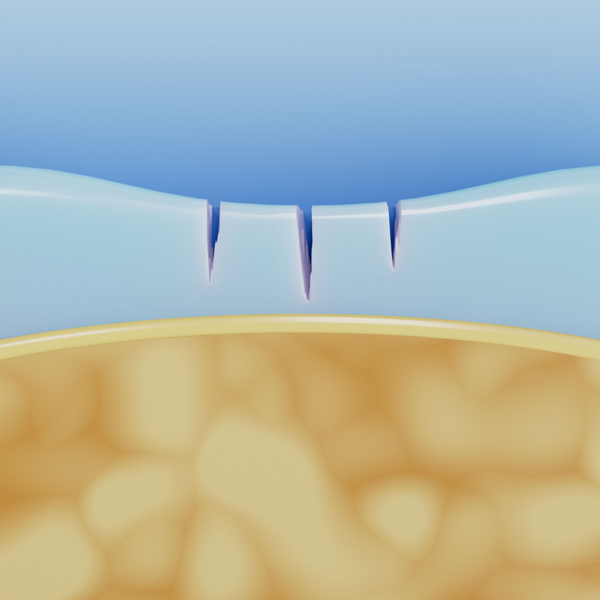 3D graphic: Image showing grade 2 cartilage damage